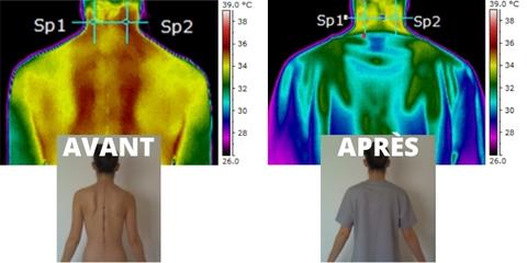 wil.life-wil-wil-life-wavesimpulselife-science-textile-antalgique-resultat-thermographie-avant-après-thermal