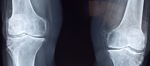 Xray of knee joints