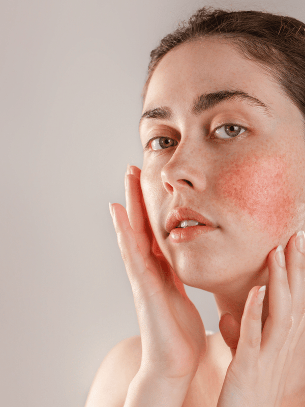 Rosacea Understanding It And How To Treat It Colorblack 