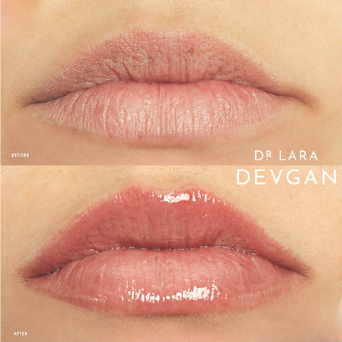 Dr. Lara Devgan Scientific Beauty Platinum Lip Plump SPF Before + After