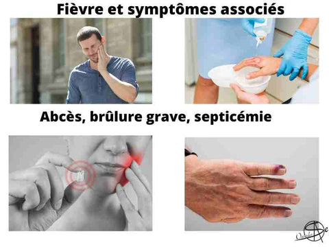 Quels symptômes associés à une fièvre sont caractéristiques d'un abcès, d'une brûlure infectée, d'une septicémie?