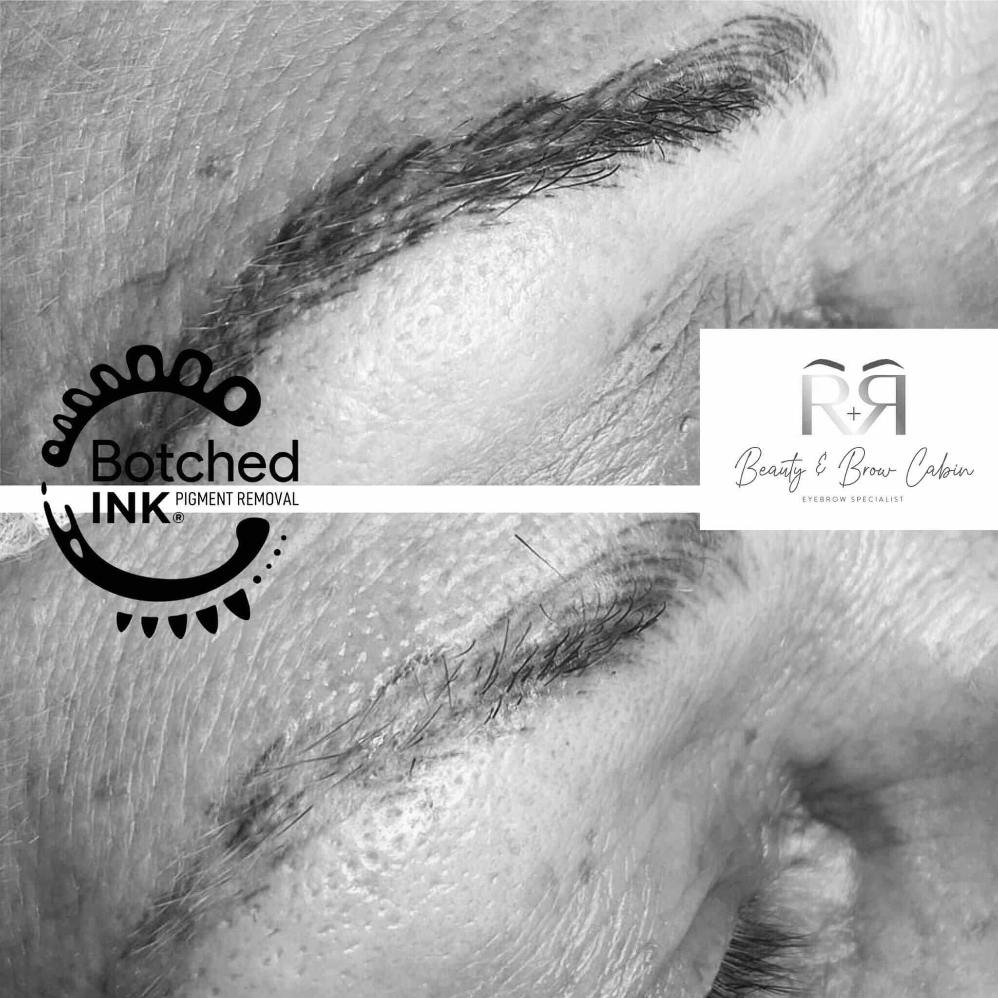 Saline Tattoo RemovalLightening  Lobrows