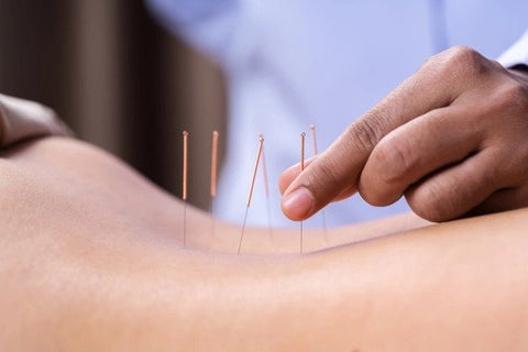woman undergoing acupuncture treatment for back