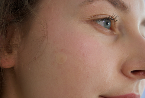 Does Dairy Cause Acne?