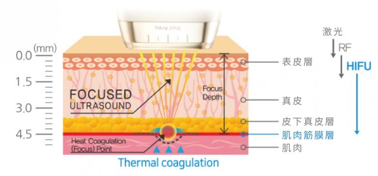 Dualsonic Thermal Coagulation Diagram | Dualsonic Professional HIFU Treatment Machine | BeautyFoo Mall Malaysia