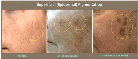 The different types of skin hyperpigmentation - Best Skincare for Pigmentation malaysia - BeautyFoo Mall