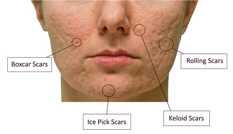 Types of Acne Scars | How to Remove Acne Scars Naturally | BeautyFoo Mall Malaysia