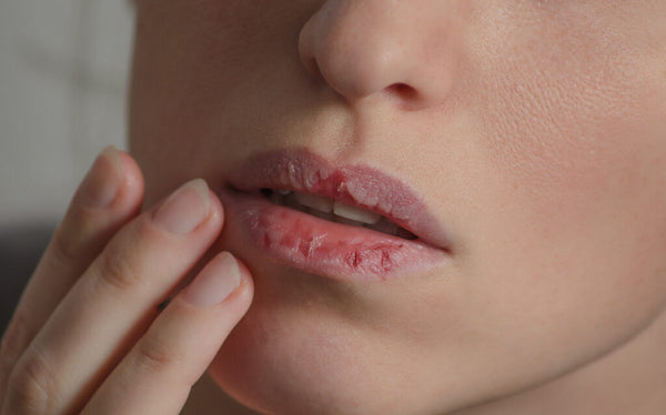 Avoid touching your lips and peel off lip skin