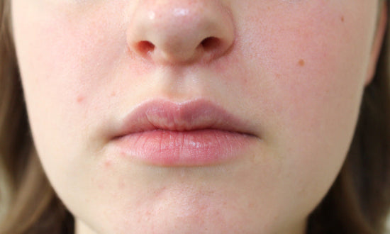 A sign of perioral dermatitis is a bright visible triangle that forms between the nose and mouth.