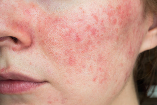 Rosacea ist eine Hauterkrankung, die sich mit Rötungen zeigt