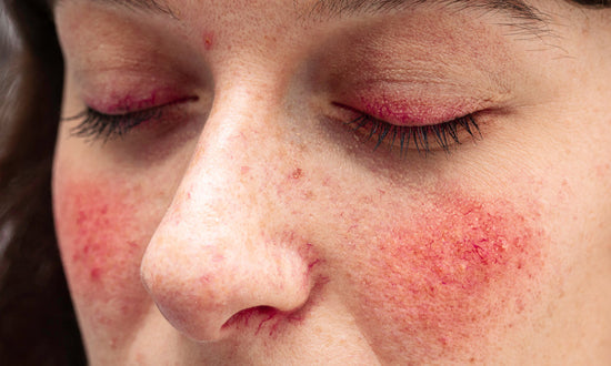 Woman with rosacea: Extensive redness on the cheeks and eyelids