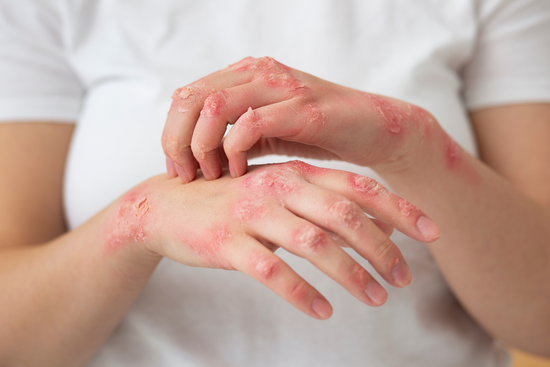 Psoriasis Management Pure Culture