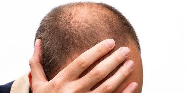 The History of Male Hair Loss Treatments