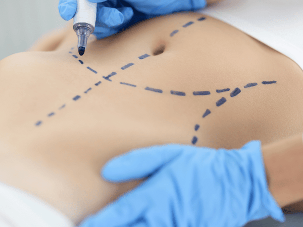 Surgical Procedures (e.g., Liposuction)