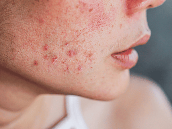 An image of a woman showing a side of her cheeks full of acne.
