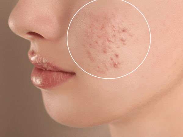 Acne Scars