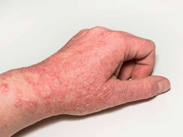an image of a hand with eczema