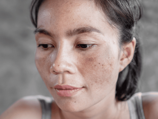 An image of an Asian woman with sun-damaged skin on her face.