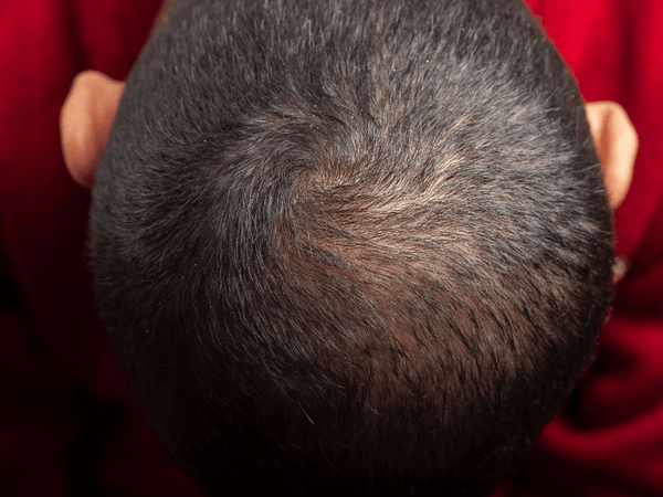 an image of a man Androgenetic Alopecia