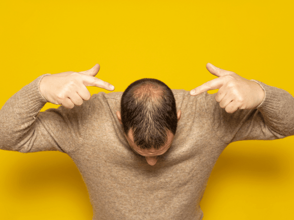 an image of a man with Androgenetic Alopecia