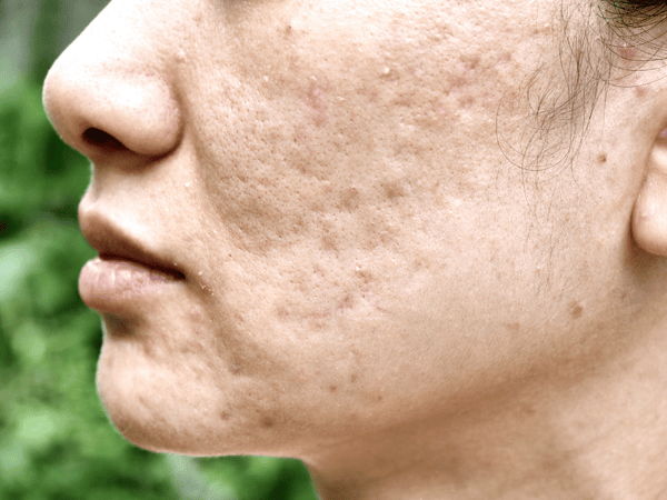 An image of a woman with acne scars.