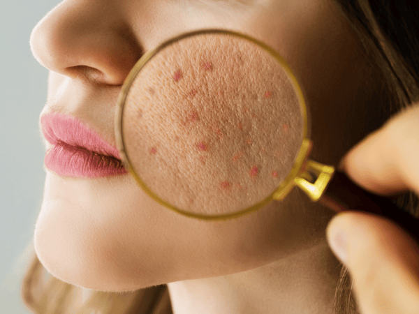 an image of a woman with acne.