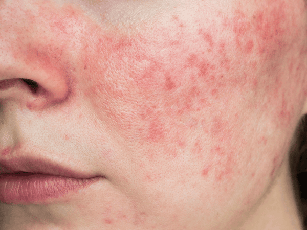 an image of a woman with Rosacea