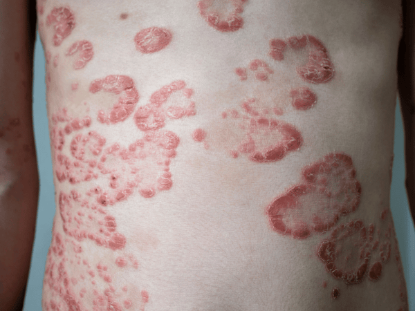 An image of a person with psoriasis.