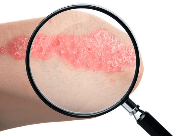 an image of an elbow with psoriasis being looked at under a magnifying glass.