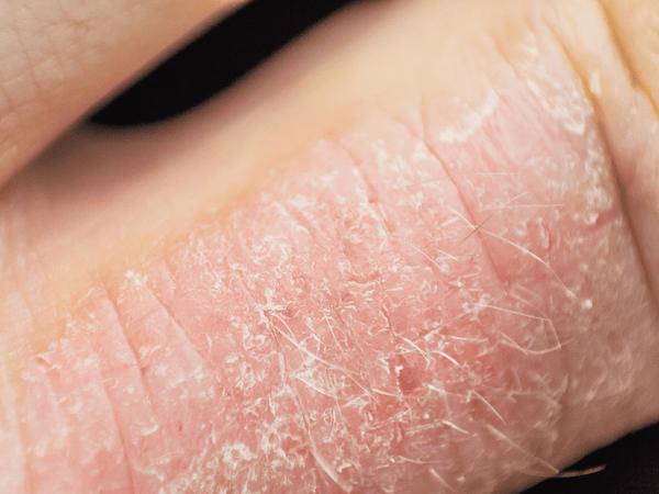 a close up image of dry skin suffering from eczema.