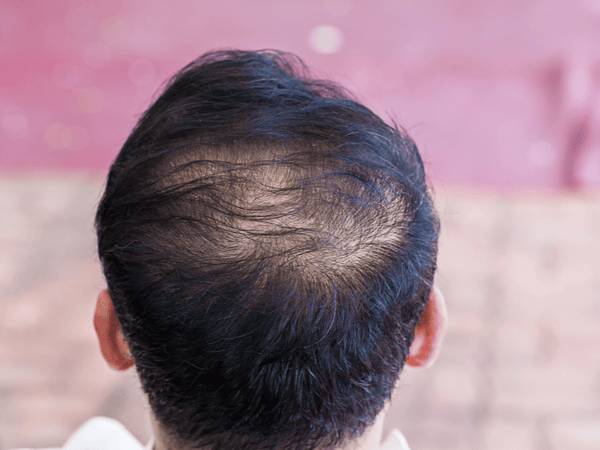 an image of a man with balding scalp.