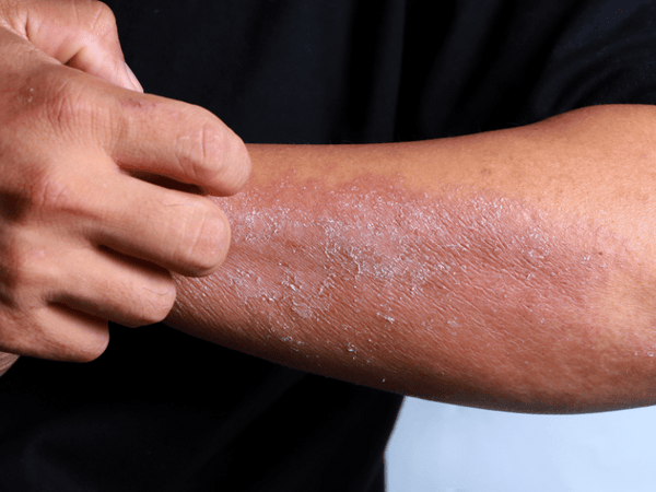 An image of a man scratching his wrist that is infected with eczema