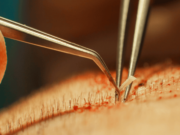 an image of a person receiving hair transplant