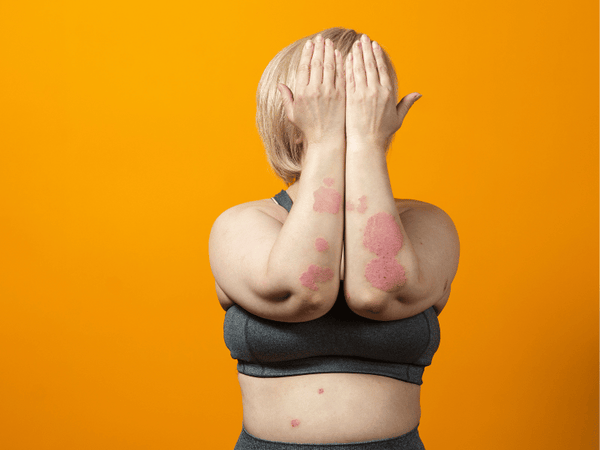 an image of a lady covering her face but her elbows are exposed showing psoriasis.