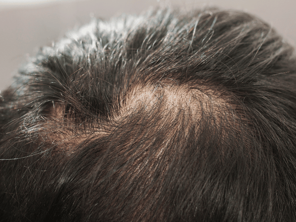 an image of an improved scalp.
