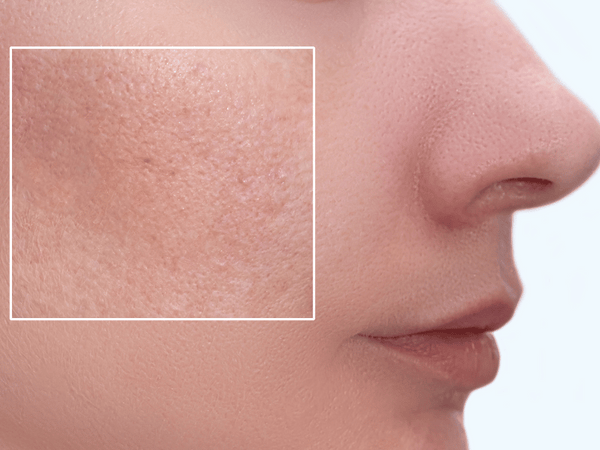 Large Pores