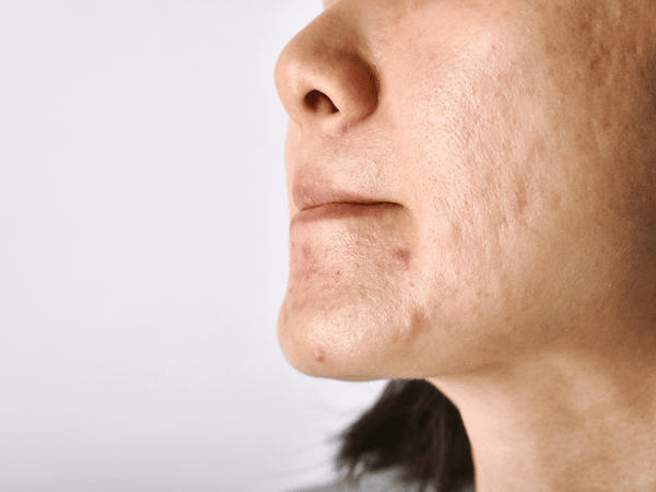 Person's Face with Acne Scars and Pimples