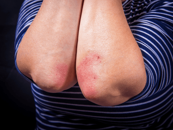 An image of a woman showing her both elbows infected with psoriasis.