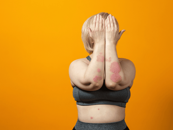 an image of a woman covering because of psoriasis.
