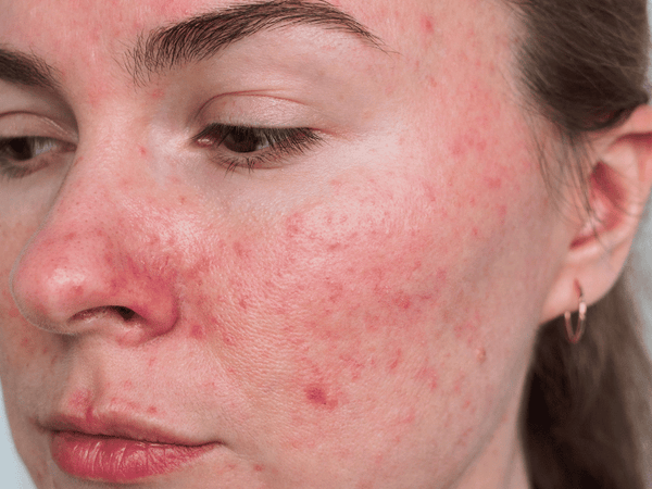 An image of a woman's face covers with rosacea.