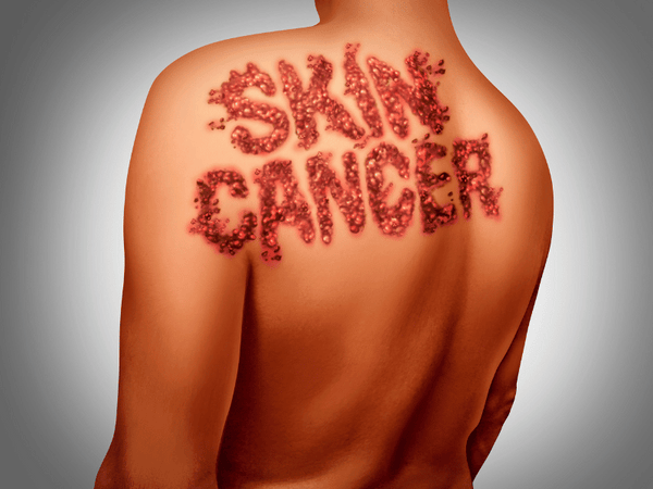 an image of a man with skin cancer