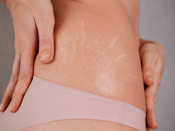 Stretch Marks