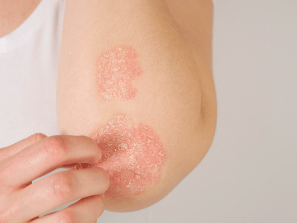 an image of a woman with psoriasis.