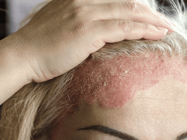 an image of a woman's forehead infected with skin psoriasis.