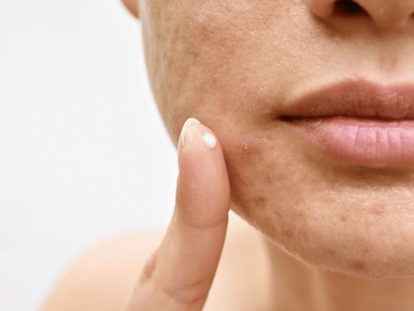 a woman using topical medications on her acne.