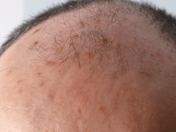 an image of a bald head with  actinic keratosis.