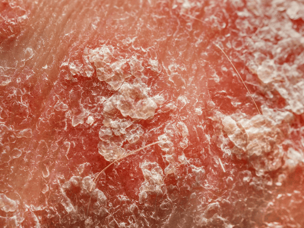 a close up image of a kin infected with psoriasis.