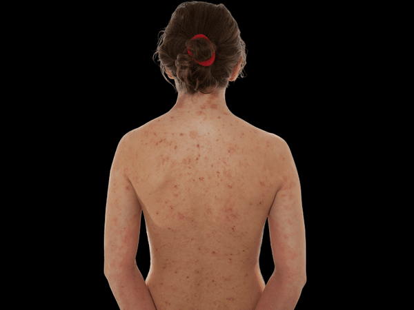 an image of a woman with atopic dermatitis.