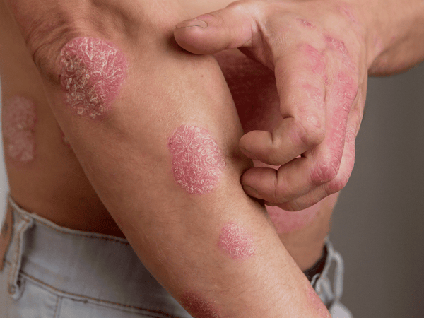 a man suffering from eczema on all over hisarms and elbows.