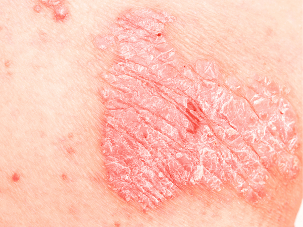 An close-up image of a skin with psoriasis.